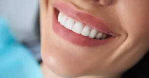 How Much Is Composite Bonding in the UK? 2025 Prices