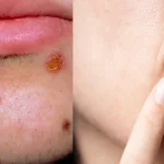 Impetigo vs Cold Sore – What’s the Real Difference?