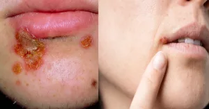 Impetigo vs Cold Sore – What’s the Real Difference? Impetigo vs Cold Sore – What’s the Real Difference?