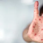 Child in Louisville Confirmed to Have Measles, Marking City’s First Case Child in Louisville Confirmed to Have Measles, Marking City’s First Case