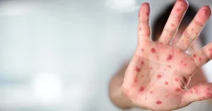 Child in Louisville Confirmed to Have Measles, Marking City’s First Case
