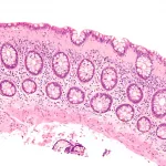 No Evidence Medications Trigger Microscopic Colitis in Older Adults No Evidence Medications Trigger Microscopic Colitis in Older Adults