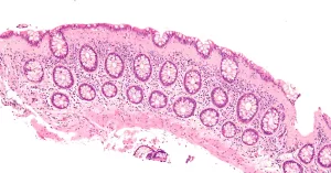 No Evidence Medications Trigger Microscopic Colitis in Older Adults No Evidence Medications Trigger Microscopic Colitis in Older Adults