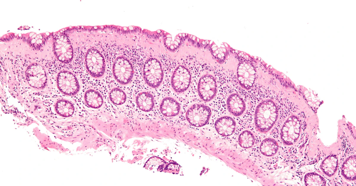No Evidence Medications Trigger Microscopic Colitis in Older Adults