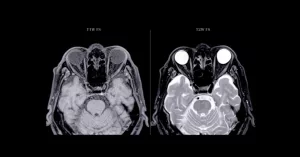 MRI With vs Without Contrast: What You Need to Know