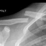 Childhood Collarbone Fractures Surge: Emergency Alert! Childhood Collarbone Fractures Surge: Emergency Alert!