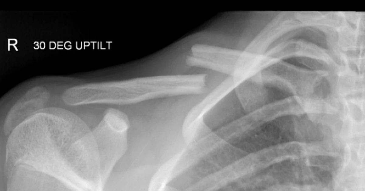 Childhood Collarbone Fractures Surge: Emergency Alert!