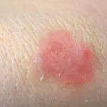 Ringworm Stages of Healing: How It Gets Better Ringworm Stages of Healing: How It Gets Better