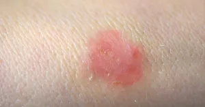 Ringworm Stages of Healing: How It Gets Better Ringworm Stages of Healing: How It Gets Better