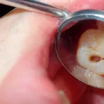 Root Canal Cracked Tooth? Here’s What to Do Next Root Canal Cracked Tooth? Here’s What to Do Next