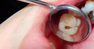 Root Canal Cracked Tooth? Here’s What to Do Next
