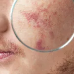 Rosacea Laser Treatment Bruising: The Truth, Care Tips, and Your Options Rosacea Laser Treatment Bruising: The Truth, Care Tips, and Your Options