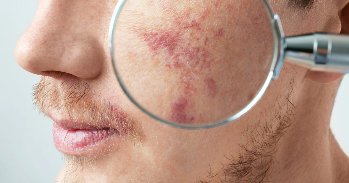 Rosacea Laser Treatment Bruising: The Truth, Care Tips, and Your Options