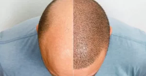 Scalp Micropigmentation with Long Hair: Real Answers, Not Fluff
