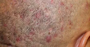 Scabs and Sores on Scalp: Pictures, Causes, Treatment Scabs and Sores on Scalp: Pictures, Causes, Treatment