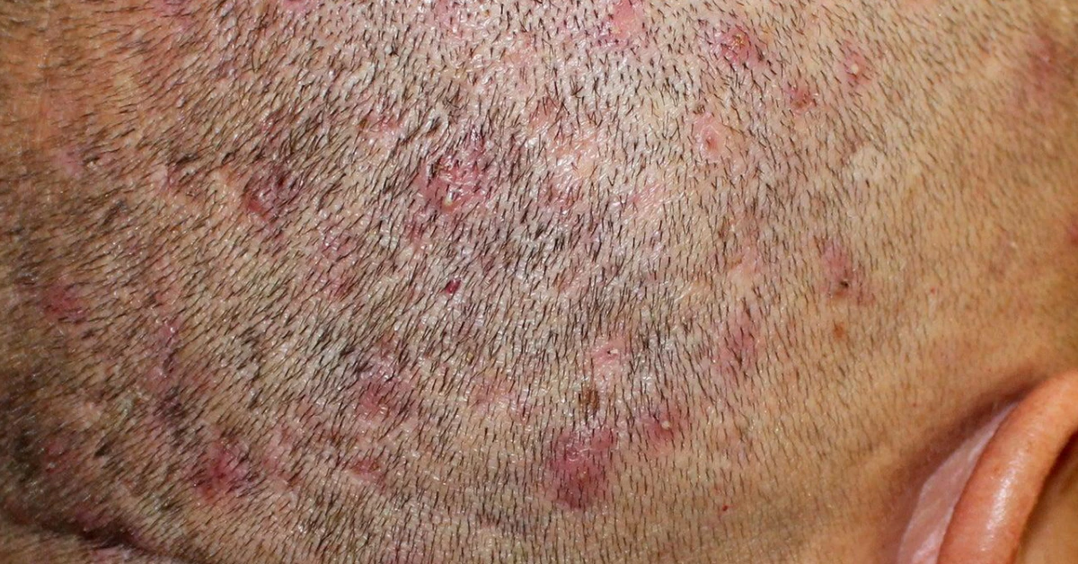 Scabs and Sores on Scalp: Pictures, Causes, Treatment