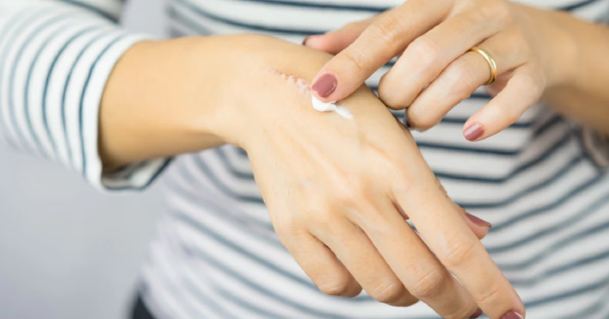 How to Reduce the Appearance of Old Scars: Best Creams & Treatments