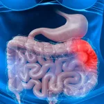 Common Bacteria Linked to 12M Stomach Cancer Cases
