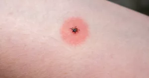 Urgent: Tick Bite ER Visits Surge This Summer Across US! Urgent: Tick Bite ER Visits Surge This Summer Across US!
