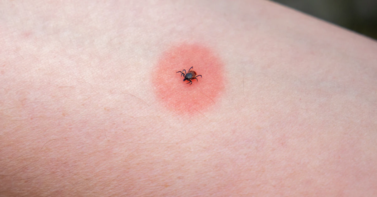 Urgent: Tick Bite ER Visits Surge This Summer Across US!