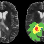 AI Maps Tumors for Radiation Therapy—But Should We Trust It? AI Maps Tumors for Radiation Therapy—But Should We Trust It?