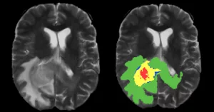 AI Maps Tumors for Radiation Therapy—But Should We Trust It?
