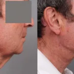 Turkey Neck Surgery Cost: Real Numbers, Tips, and Honest Advice