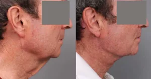 Turkey Neck Surgery Cost: Real Numbers, Tips, and Honest Advice