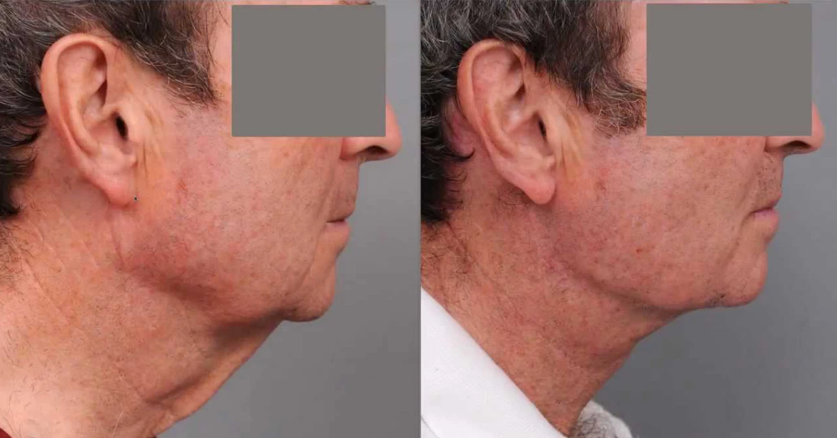 Turkey Neck Surgery Cost: Real Numbers, Tips, and Honest Advice
