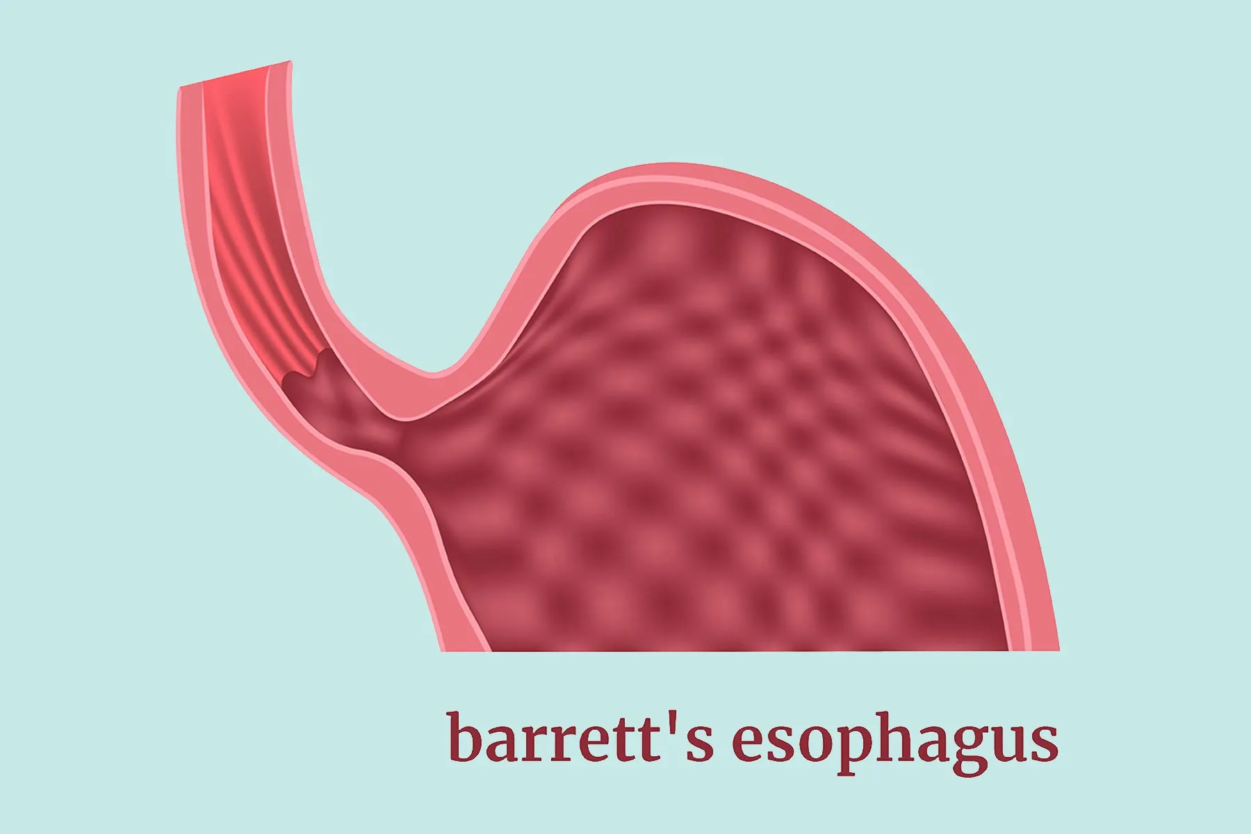 Barrett’s Esophagus Explained: Risks, Screening & Care