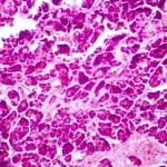 3D Bioprinting Islets: A New Hope for Diabetes