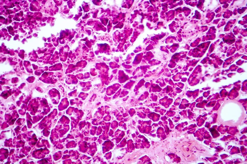 3D Bioprinting Islets: A New Hope for Diabetes