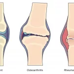 Understanding Inflammatory Joint Diseases: Find Relief