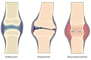Understanding Inflammatory Joint Diseases: Find Relief Understanding Inflammatory Joint Diseases: Find Relief