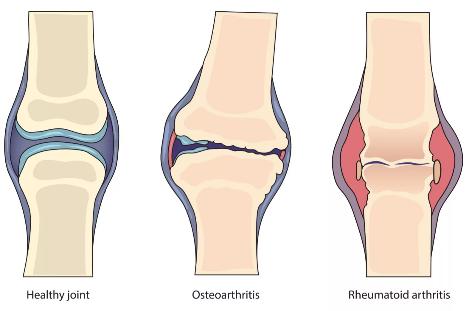 Understanding Inflammatory Joint Diseases: Find Relief