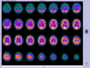 Radiotracer Brain Imaging: Quick Answers & Guide