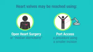 Choosing the Right Replacement Heart Valve: Your Guide