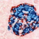 Essential Type 1 Diabetes Treatment Options for You