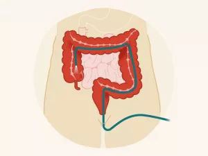 Understanding Colon Cancer Screening Tests Guide