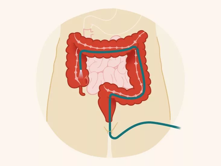 Understanding Colon Cancer Screening Tests Guide