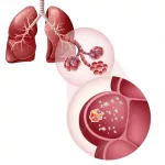 Silicosis Causes: Why Your Lungs Might Be at Risk Silicosis Causes: Why Your Lungs Might Be at Risk