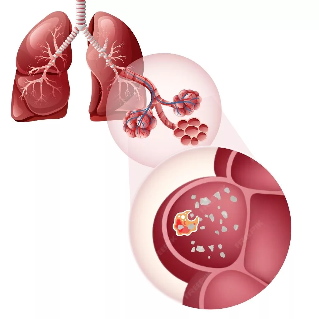Silicosis Causes: Why Your Lungs Might Be at Risk