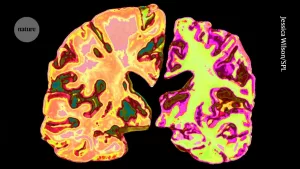 Alzheimer’s Treatment Alternatives: Natural Paths to Hope