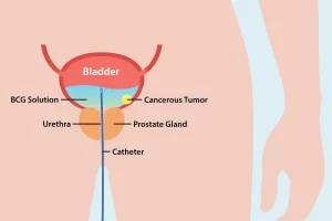 Understanding BCG Therapy: What It Means for You