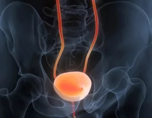Predict & Prevent Bladder Cancer Recurrence Now