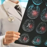 Hopeful Brain Ischemia Treatment Options You Know Hopeful Brain Ischemia Treatment Options You Know