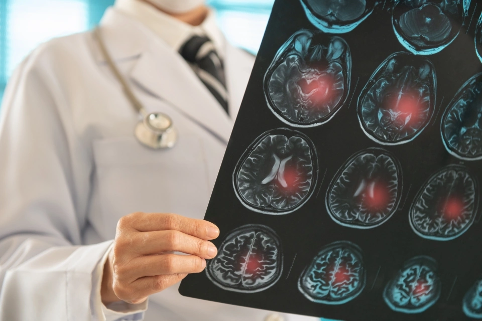 Hopeful Brain Ischemia Treatment Options You Know
