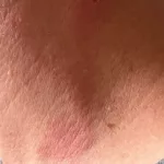 What You Need to Know About Cicada Mite Bites What You Need to Know About Cicada Mite Bites