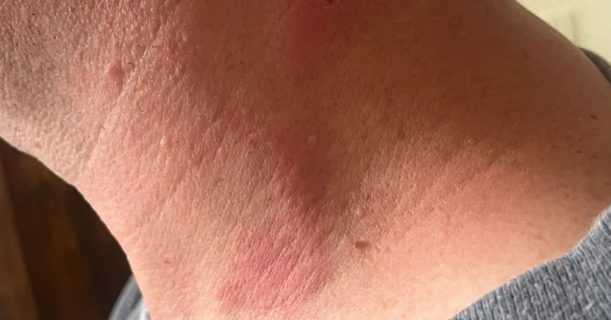 What You Need to Know About Cicada Mite Bites