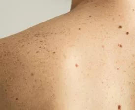Genetic Skin Condition: What It Is, Symptoms & Treatment